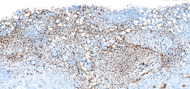 Dermatitis IHQ P. salmonis I