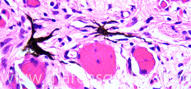 Malnomacrophages I