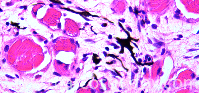 Malnomacrophages II