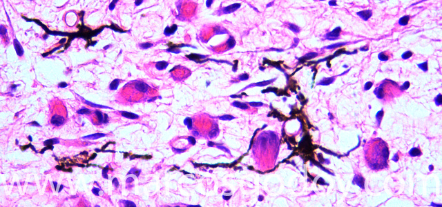 Malnomacrophages IV