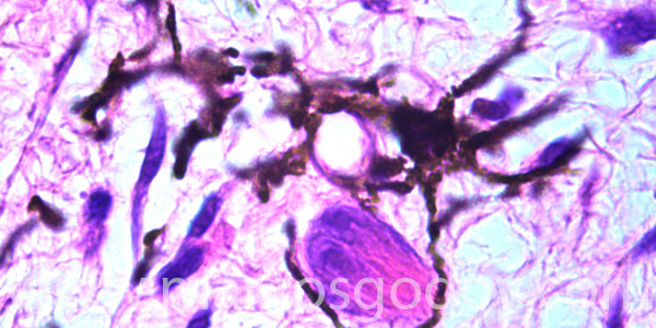 Malnomacrophages IX