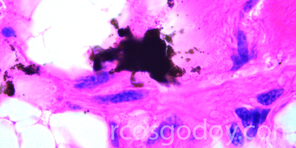 Malnomacrophages X