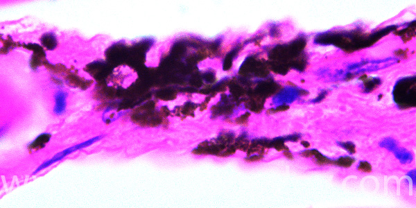 Malnomacrophages XI