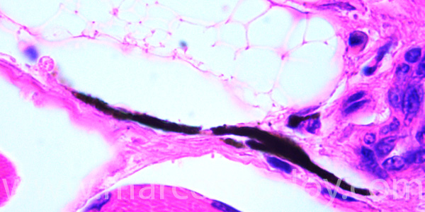 Malnomacrophages XII