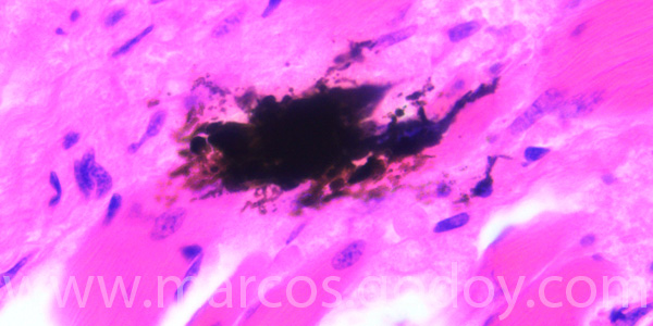 Malnomacrophages XIII