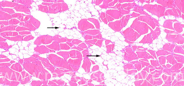 Muscular esteatosis I