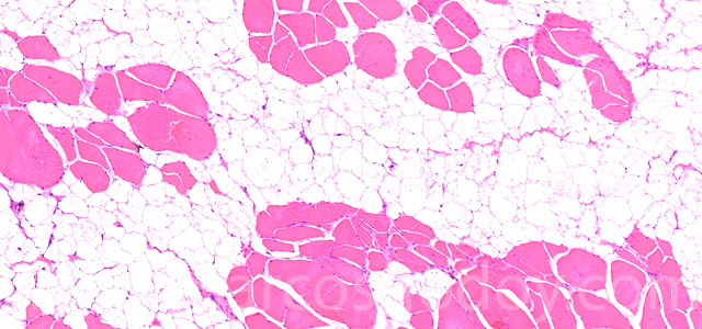 Muscular esteatosis IIII