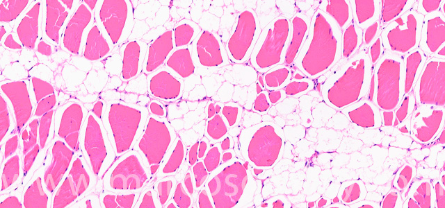 Muscular esteatosis IV