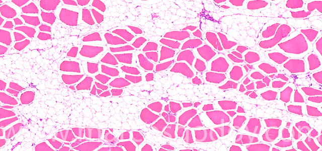 Muscular esteatosis V
