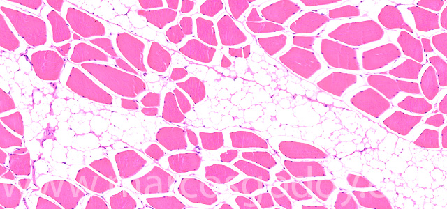 Muscular esteatosis VI