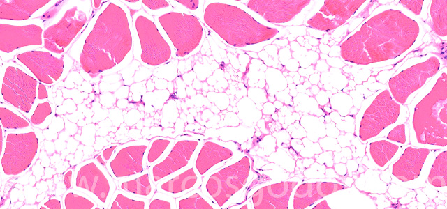 Muscular esteatosis VII